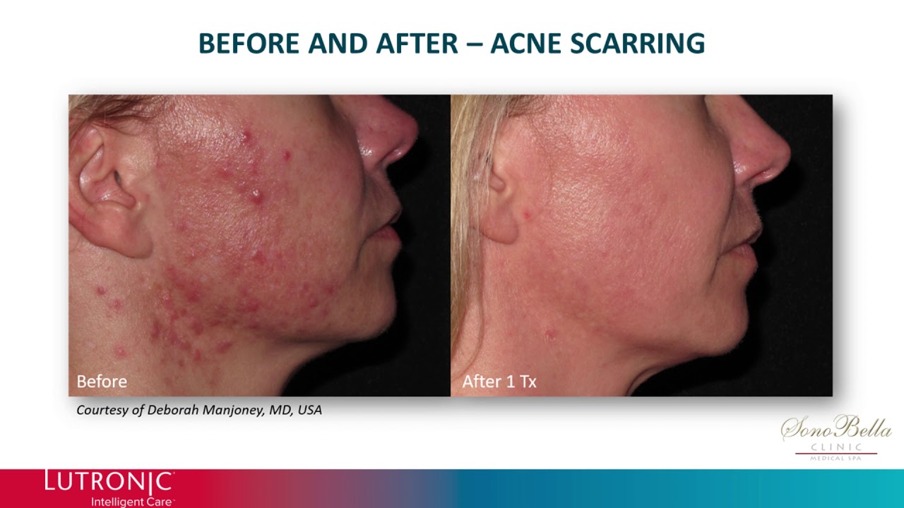 Genius Laser - before and after video