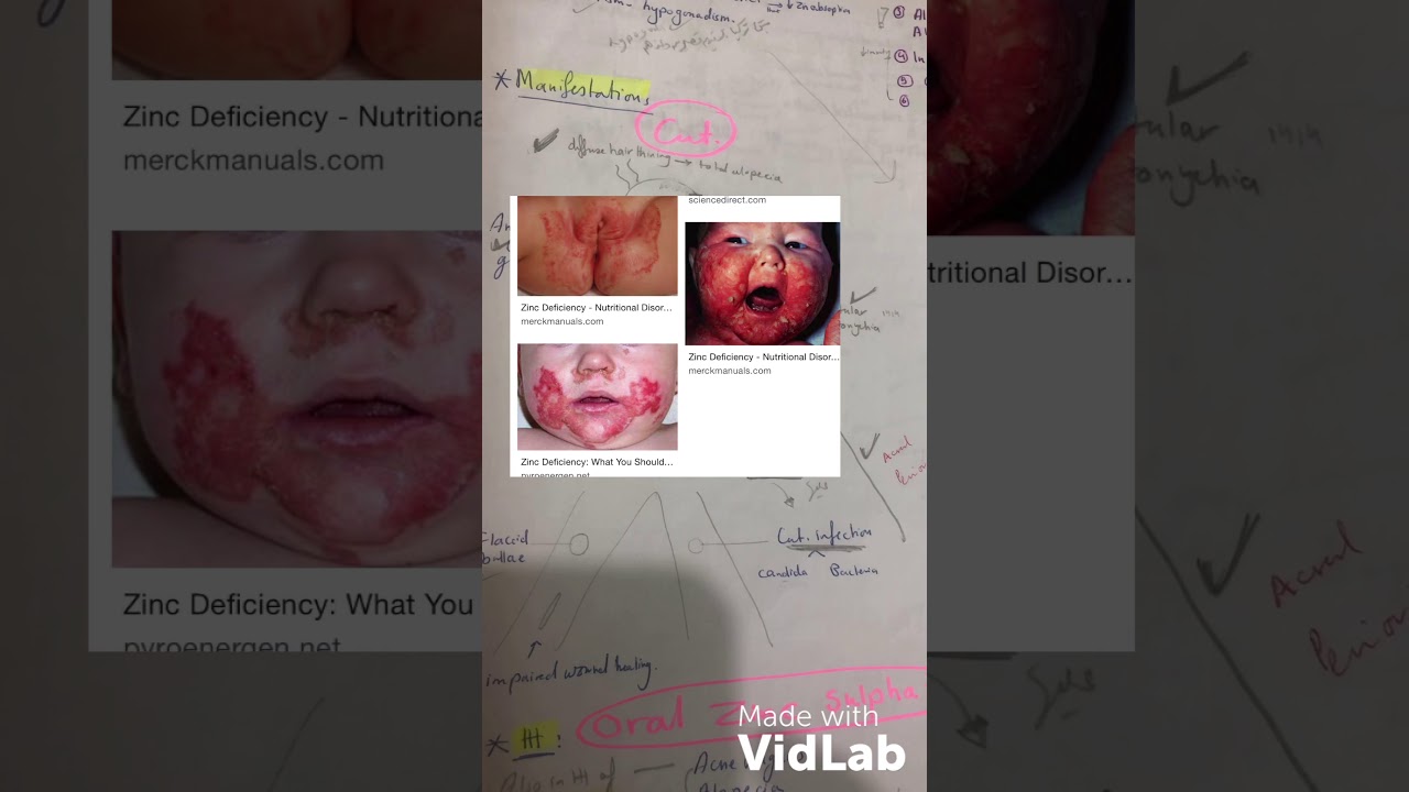 Cutaneous manifestations of nutritional deficiency   Zinc deficiency  acrodermatitis enteropathica