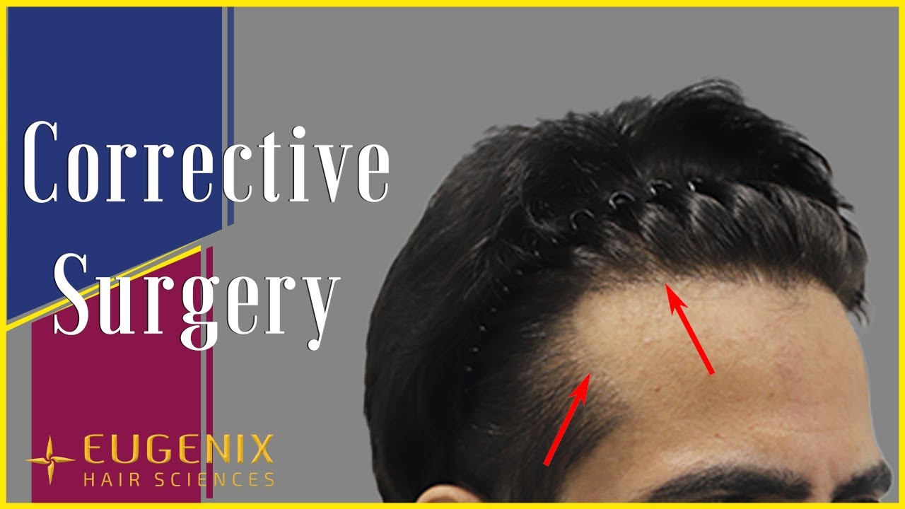 Corrective Hair Transplant procedure I Patient Testimonial I @EugenixHairSciencesofficial