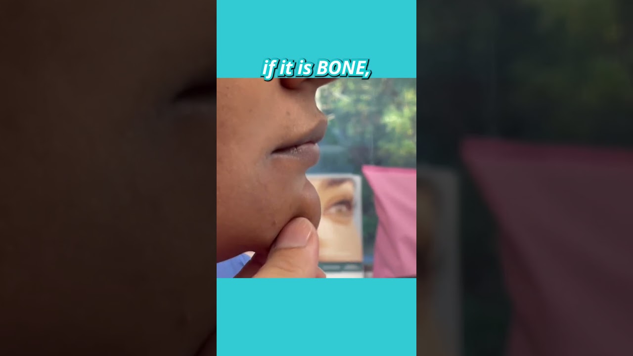 Is it BONE or SKIN? Dr. Janjua explains a soft tissue CHIN REDUCTION