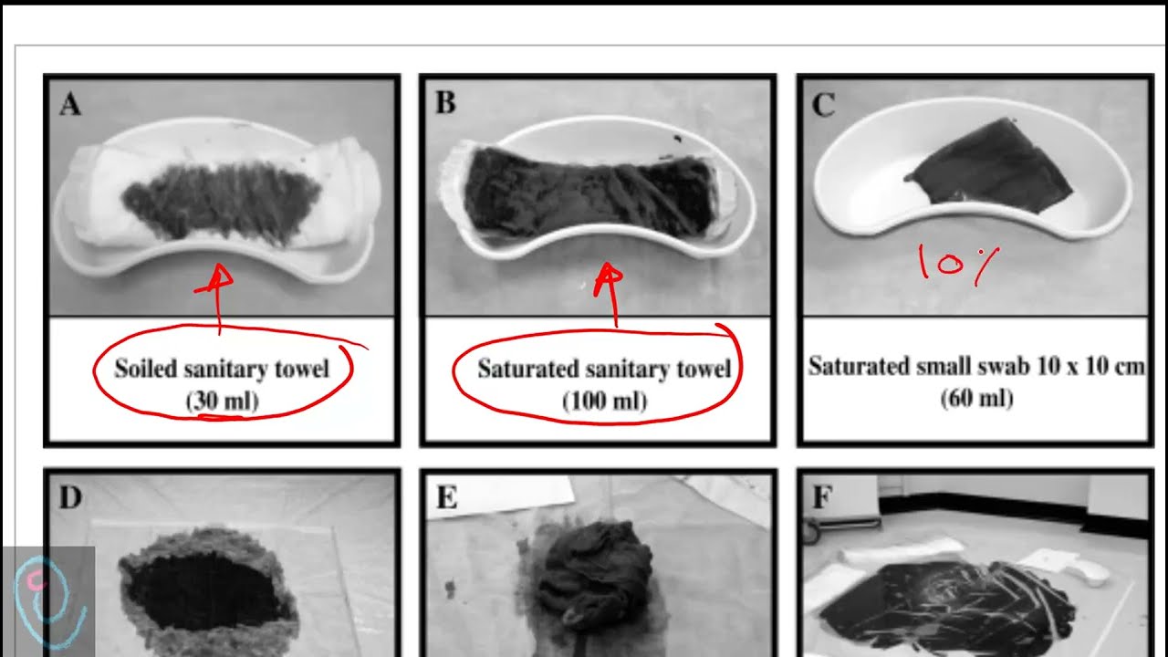 Visual estimation of blood loss