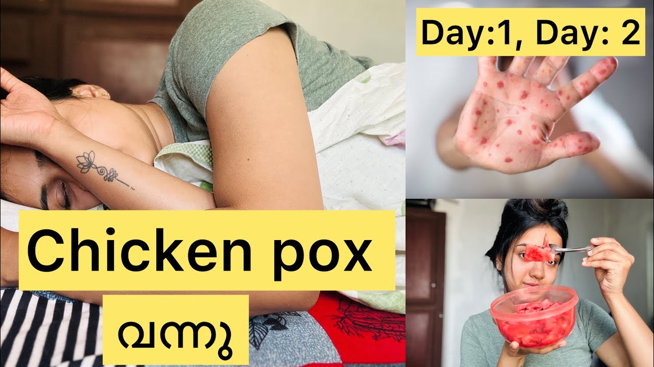 Chicken pox വന്നു 🥹/day : 1 ,day : 2😔