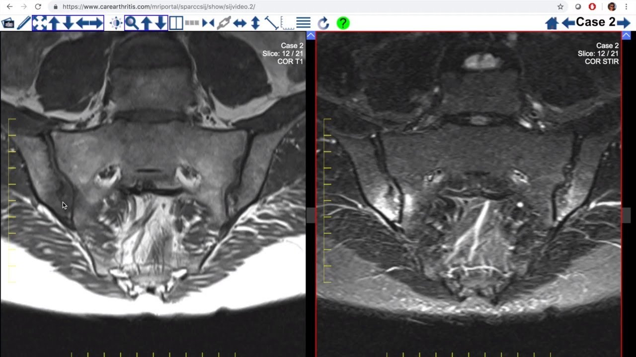 MRI lesions in the sacroiliac joints of patients with spondyloarthritis
