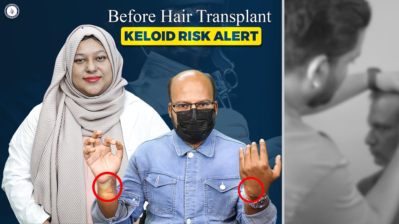 Before Hair Transplant, Watch This | Keloid Risk Alert ⚠️ | Bangladesh