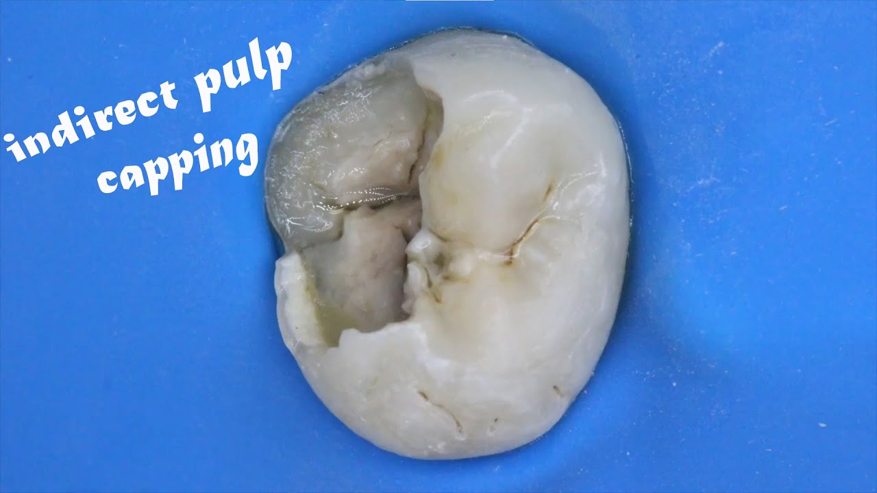 Indirect Pulp capping