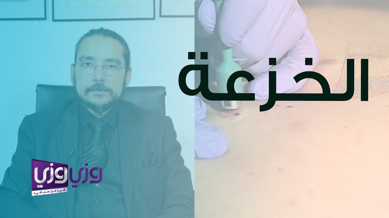 ما هي الخزعة، وما دورها في اكتشاف الأورام
