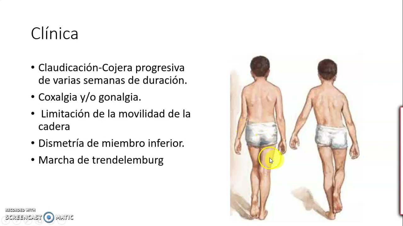 LEGG CALVE PERTHES