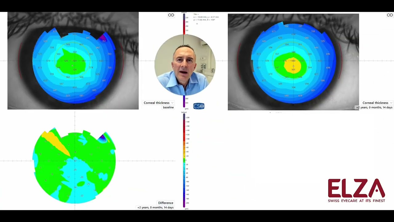 ELZA-PACE for progressive keratoconus in a 19 year old