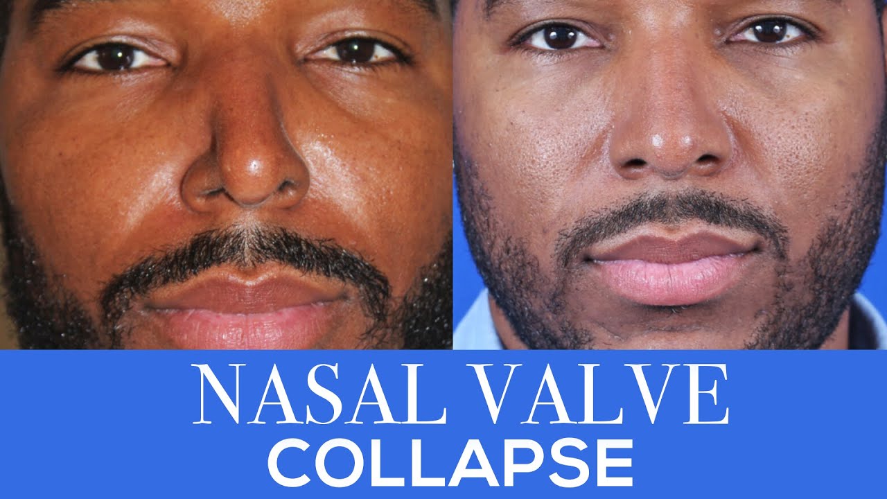 How To Fix A Collapsed Nasal Valve | Dr  Moustafa Mourad | Mourad NYC