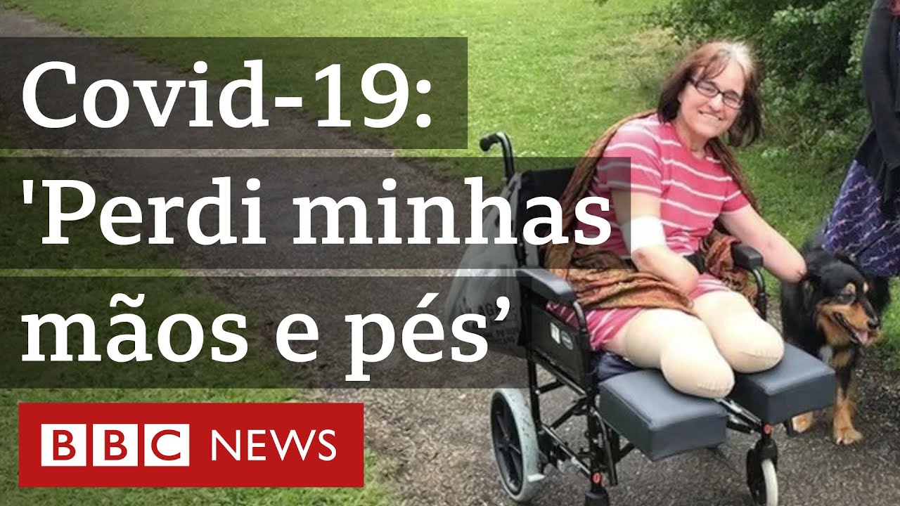A mulher que perdeu mãos e pés depois de ter covid-19