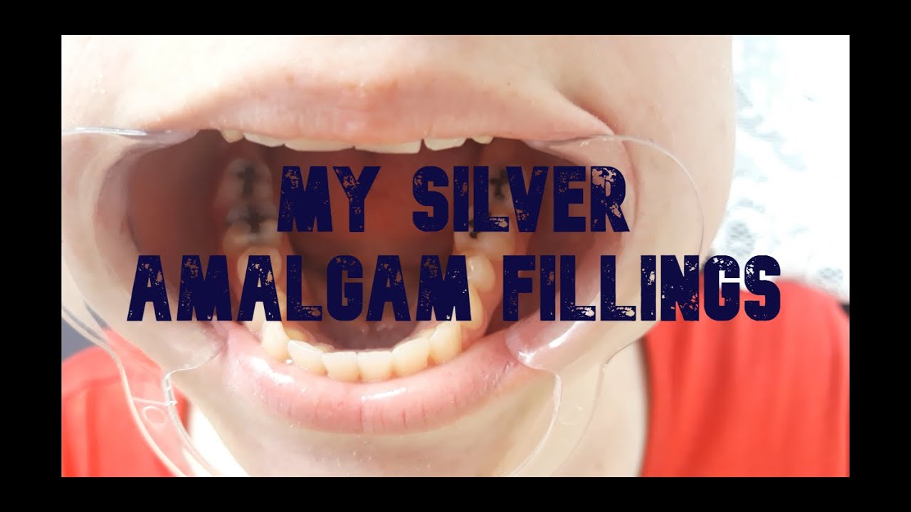 MY 7 SILVER AMALGAM TOOTH FILLINGS