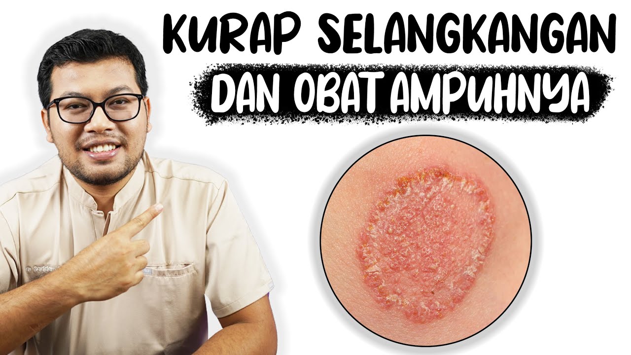 kurap diselangkangan atau Tinea Cruris - DOKTER SADDAM ISMAIL