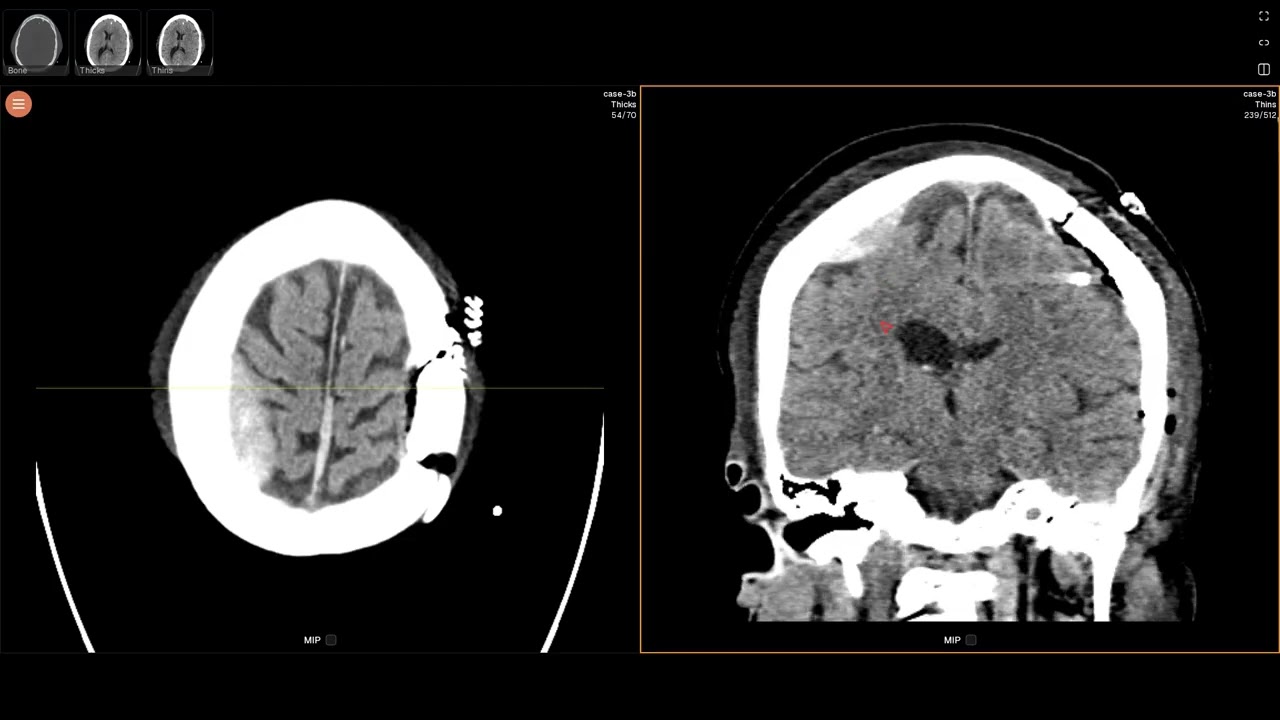 Right subdural hematoma (EDNeurorad Case 3b)