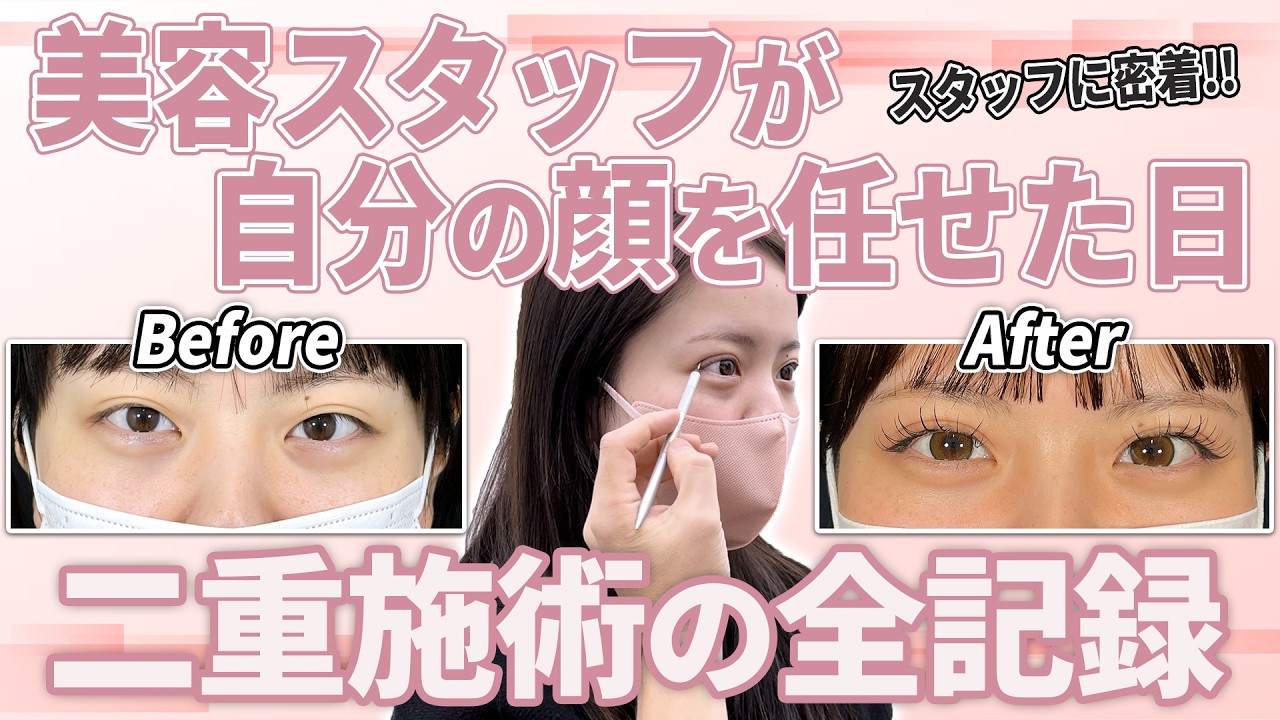 美容スタッフが“自分の顔”を任せた日｜二重施術の全記録！
