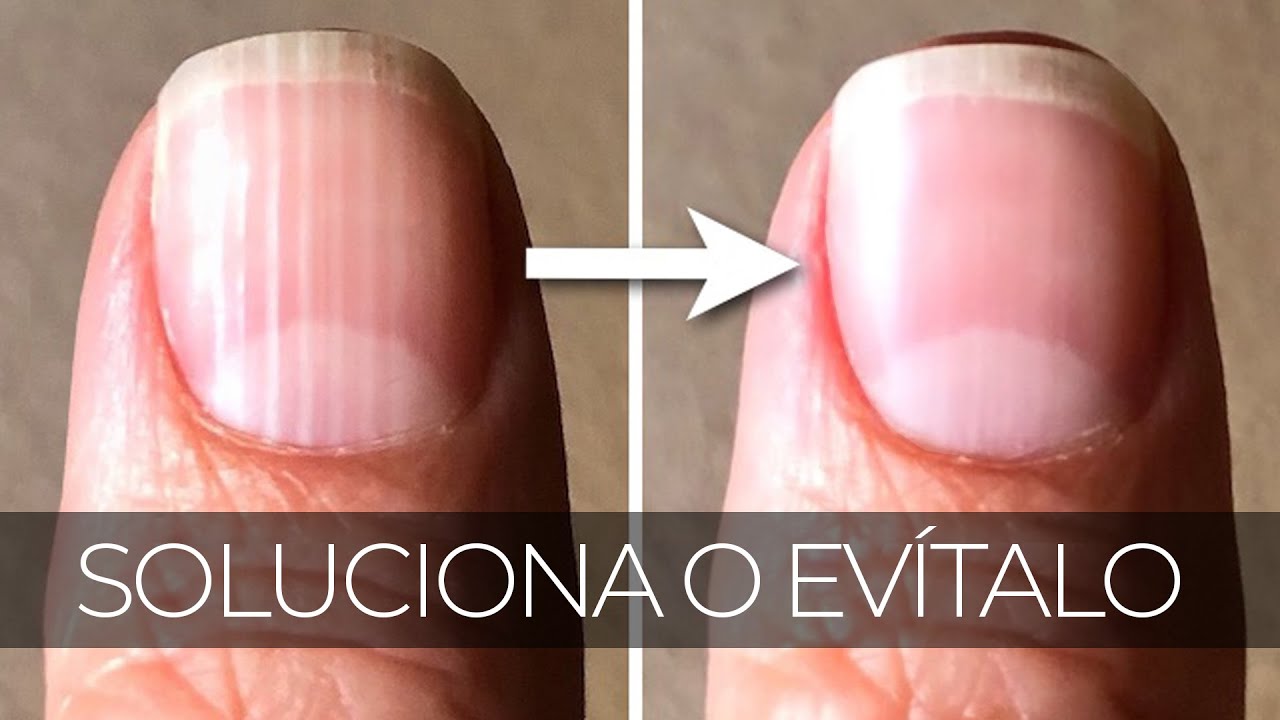 Cuidado &iquest;Por qu&eacute; salen l&iacute;neas en las u&ntilde;as y c&oacute;mo eliminarlas?