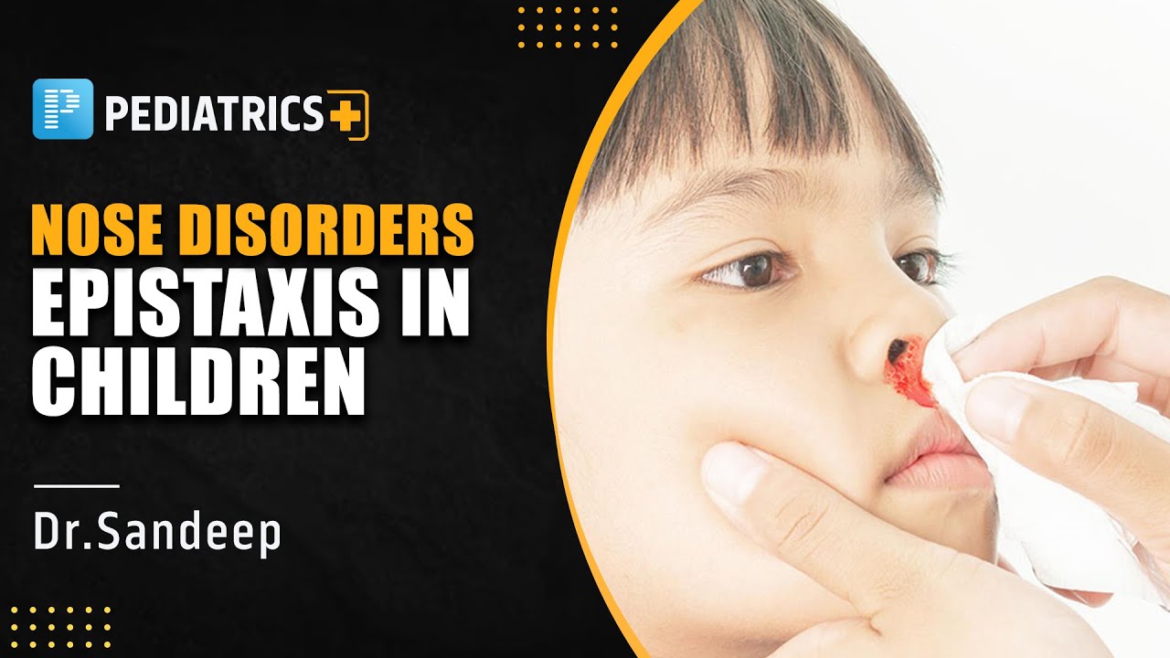 Nose Disorders - Epistaxis in Children by Dr. Sandeep Sharma | PrepLadder NEET SS
