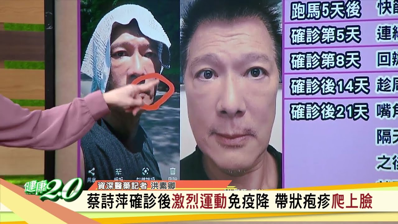 接種帶狀皰疹疫苗預防皮蛇上身 健康2.0