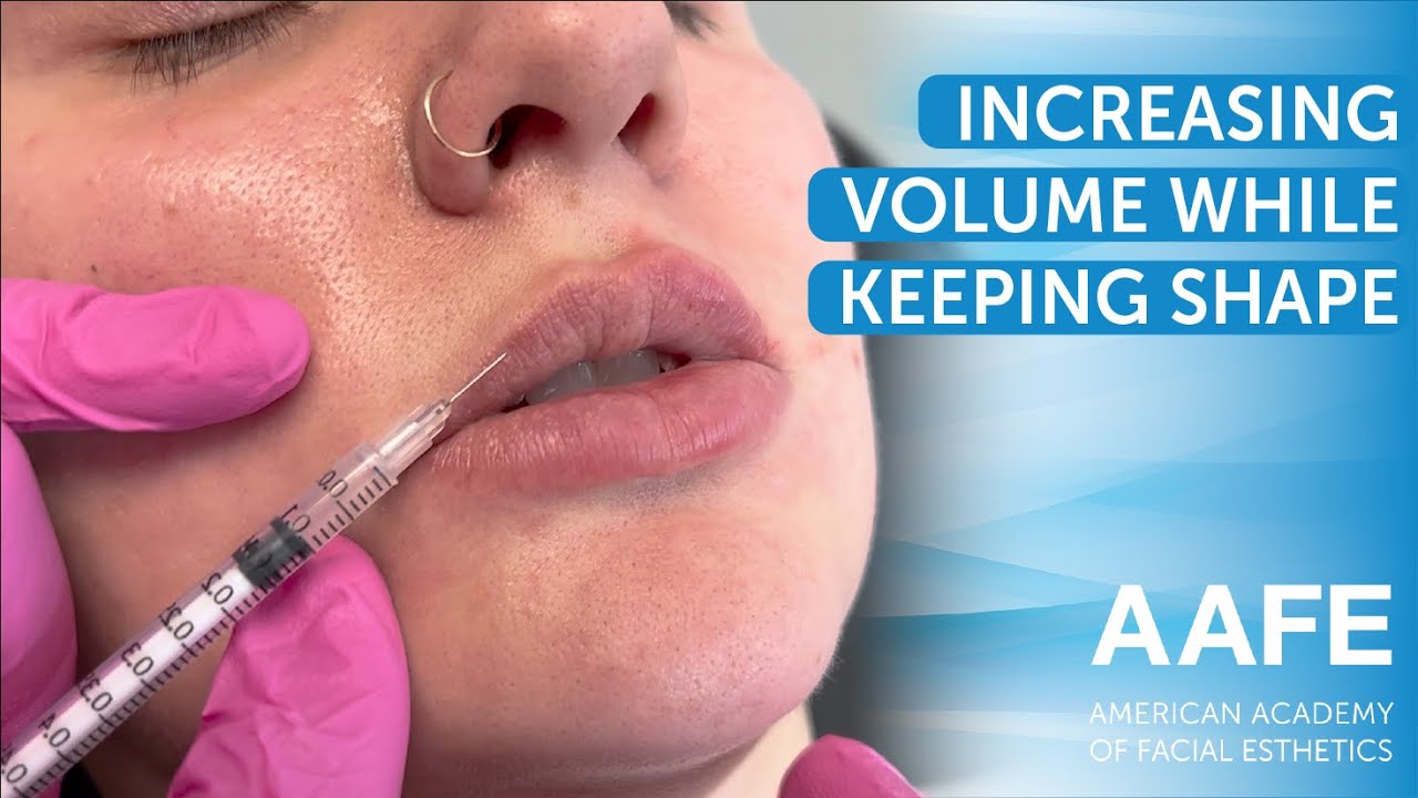 Increasing Lip Volume but Keeping the Shape