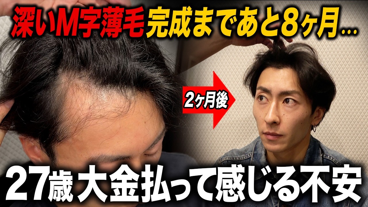 【植毛4ヶ月】27歳が感じる現実。大金を払ってもまだ結果が見えない不安