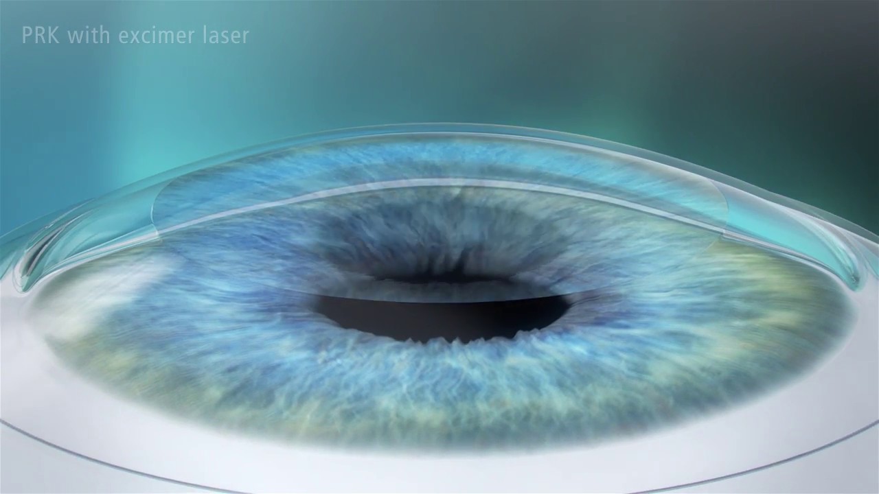 Photorefractive Keratectomy (PRK) Laser Eye Surgery