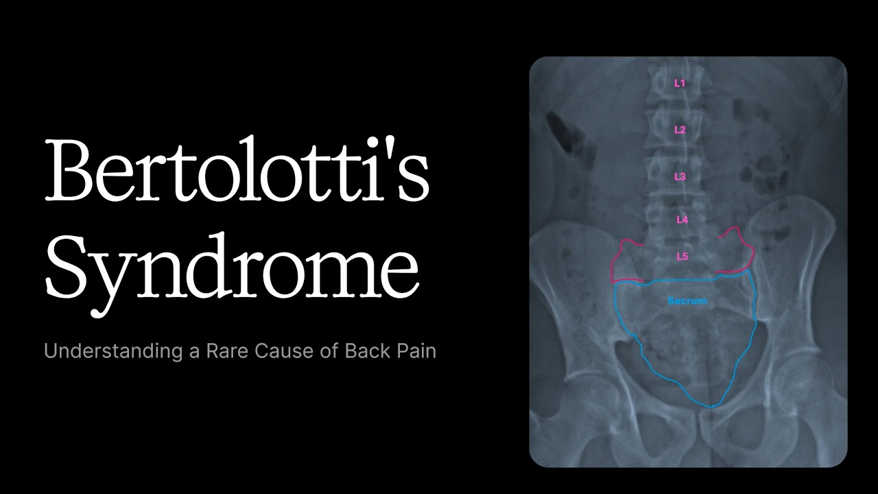 Bertolotti's Syndrome - An Often Overlooked Cause of Back Pain