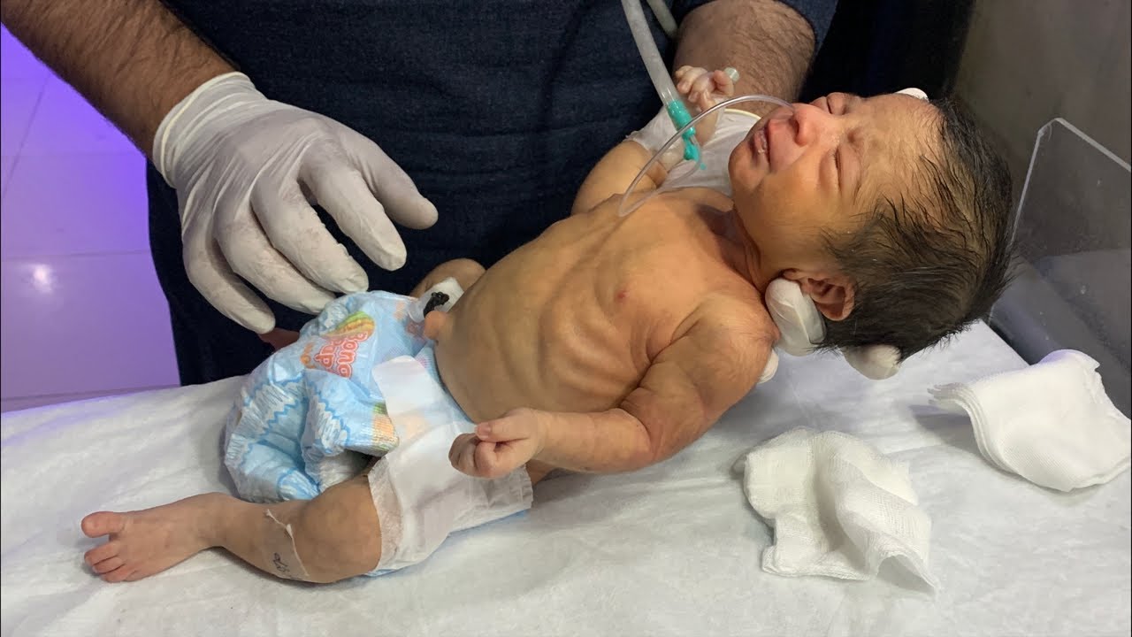 NICU Baby Recovery &ndash; Real Stories, Physio, & Shocking Transformations