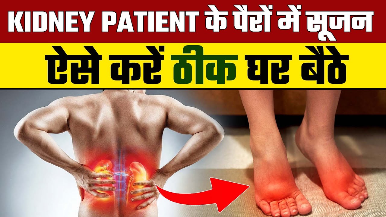 Kidney Patients में Leg Swelling को कैसे रोके | Treatment of Kidney Failure | Dr. Puru Dhawan