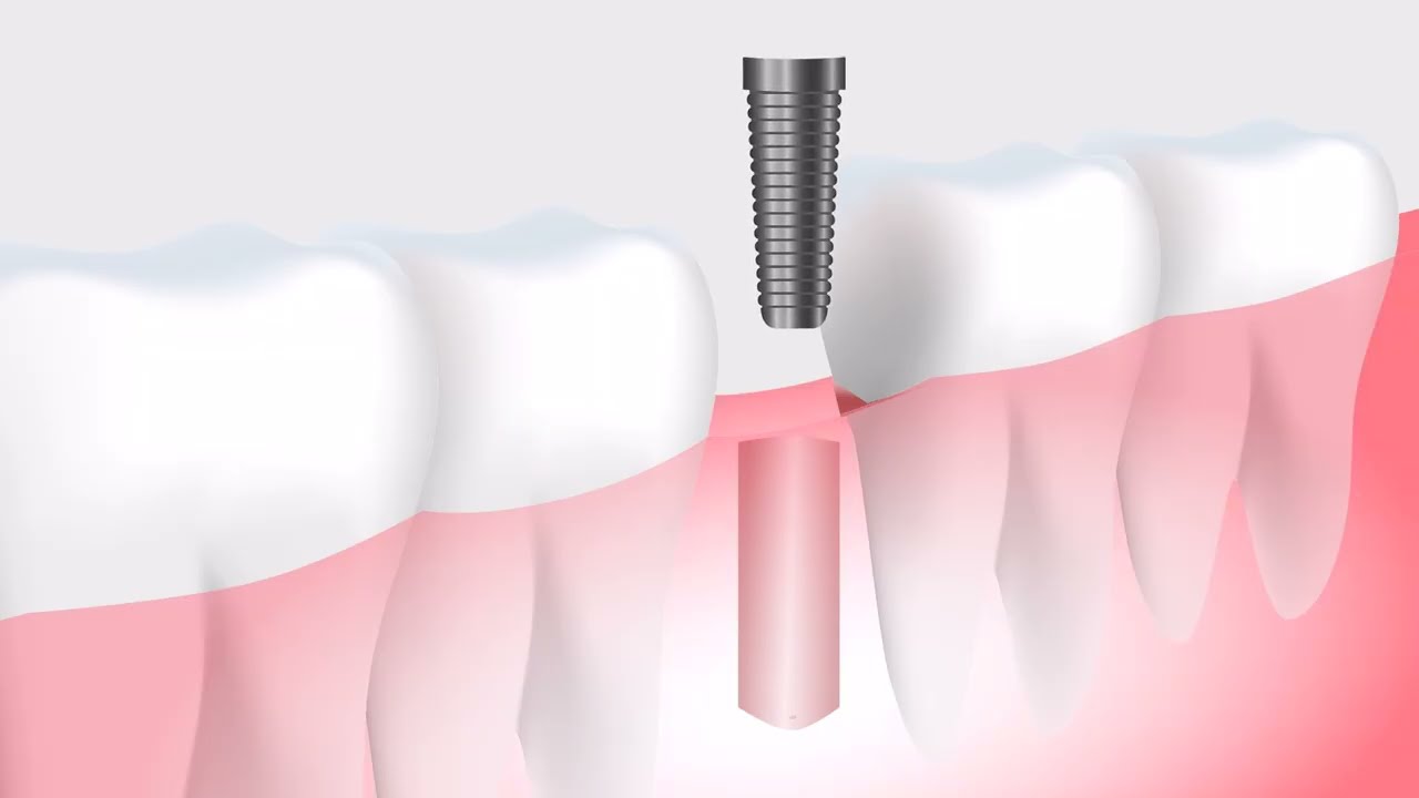 3D-анимация имплантации зуба | Пошаговое объяснение процедуры имплантации зуба