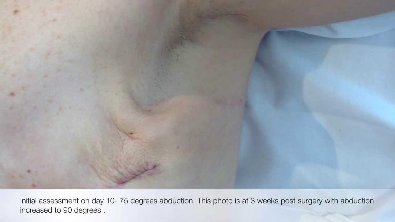 Axillary Cording Protocols Project- Breast Cancer Rehabilitation