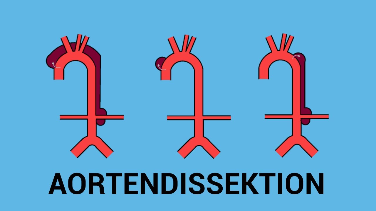 Aortendissektion einfach erklärt: Ätiologie, Klassifikation (Stanford & DeBakey), Therapie