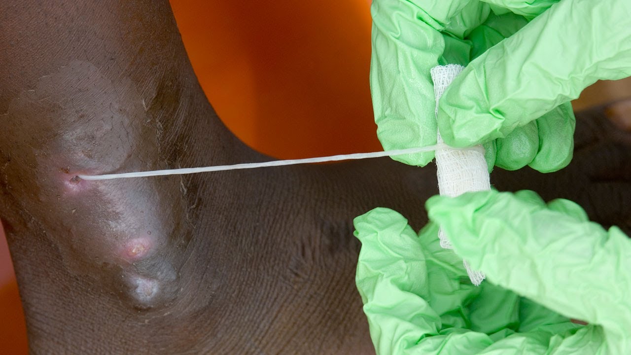 Guinea Worm Disease Eradication: Countdown to Zero  (Carter Center)