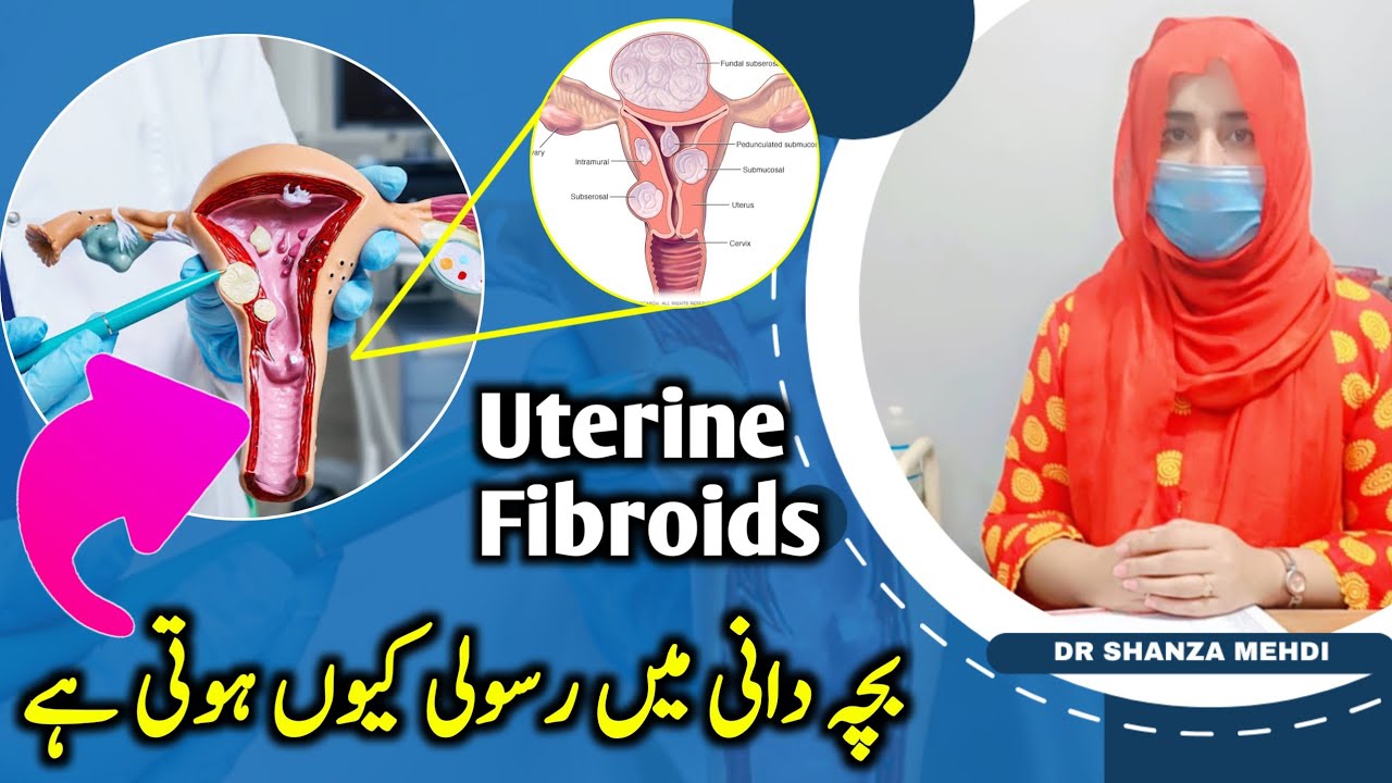 Uterine Fibroids : Causes/ Signs & Symptoms / Diagnoses &Treatment / Mehdi Medical Center Lahore