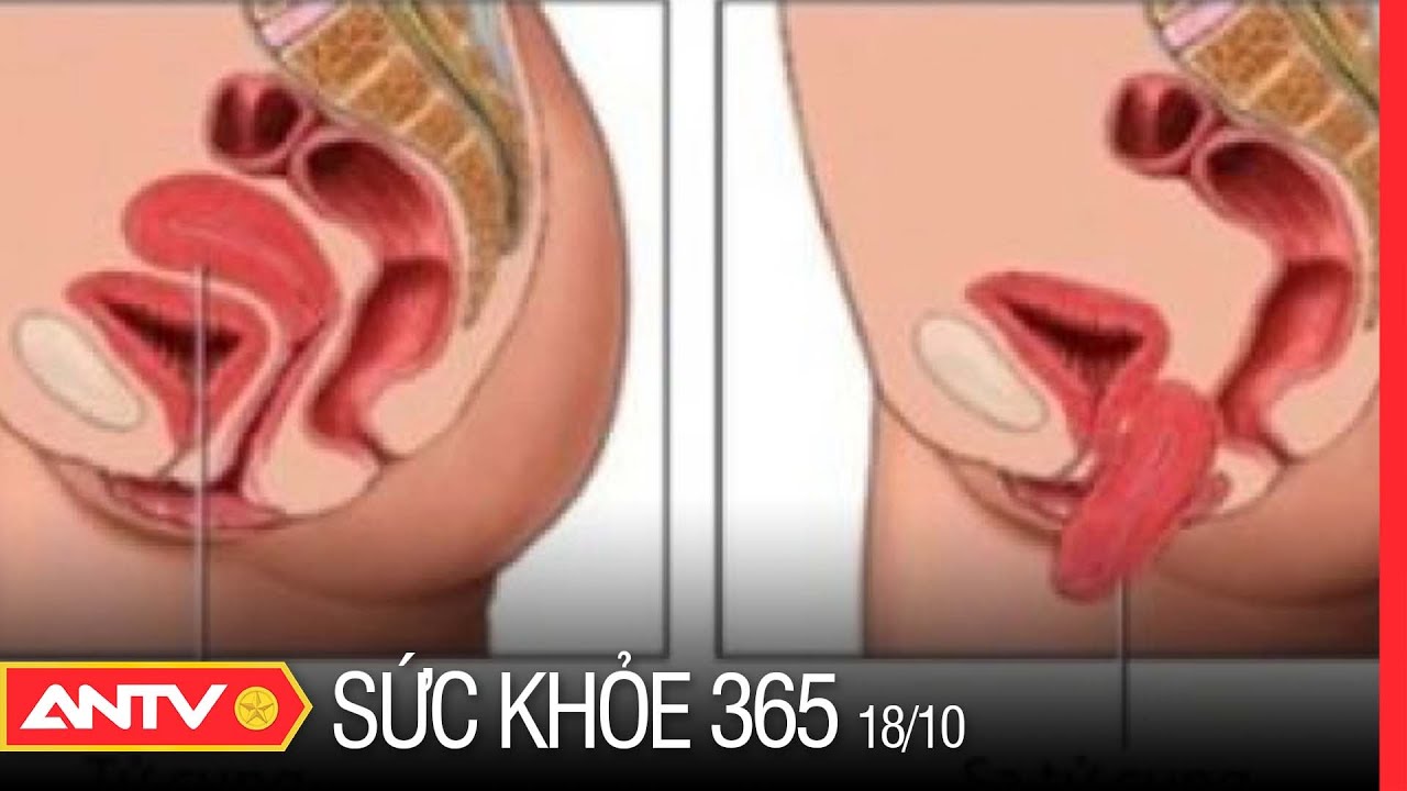 Sa Tử Cung Sau Sinh: Nguyên Nhân Và Dấu Hiệu Không Thể Bỏ Qua | Sức Khỏe 365 | ANTV