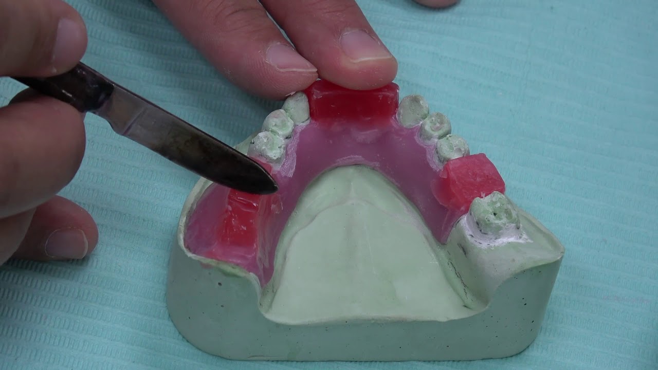 Acrylic Partial Denture - MMR (optech)
