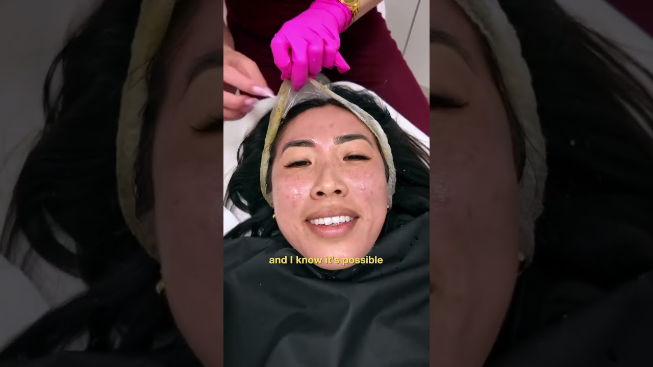 Trying green peel for my acne scars!