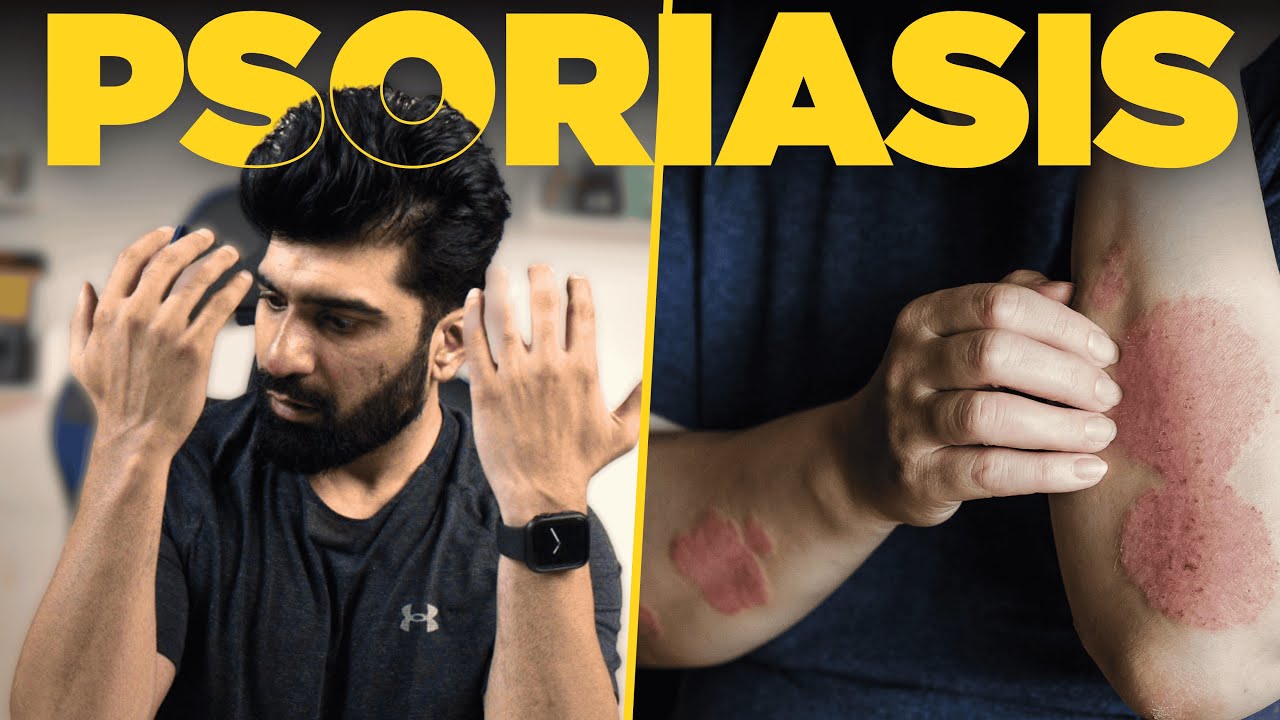 What Is Psoriasis? | Doctor Explains 🚨