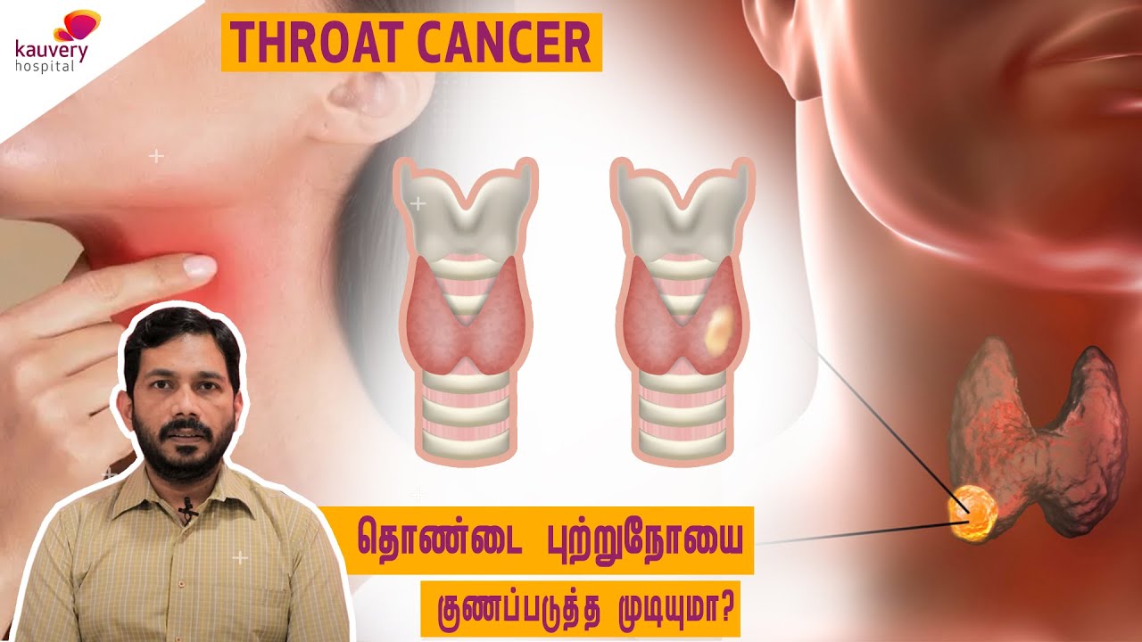 Throat Cancer - Diagnosis & Treatment | தொண்டை புற்றுநோய்