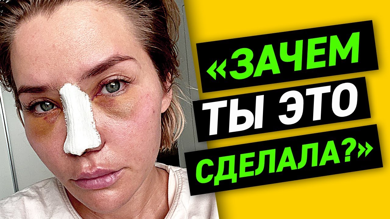 ЗАЧЕМ ТЫ ЭТО СДЕЛАЛА? | Моя ринопластика