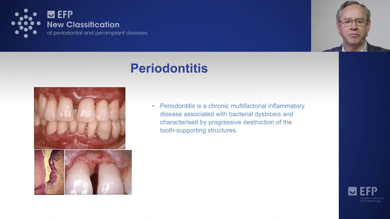 New classification of periodontitis