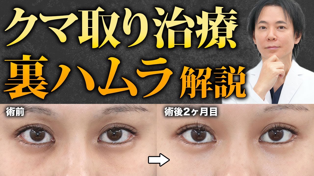 【目の下のクマ】裏ハムラ法の効果やメリット・デメリットを解説