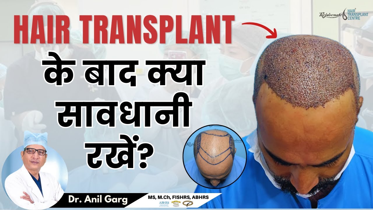 10 सावधानियां जो आपको जाननी चाहिए Hair Transplant के बाद | Care after Hair Transplant