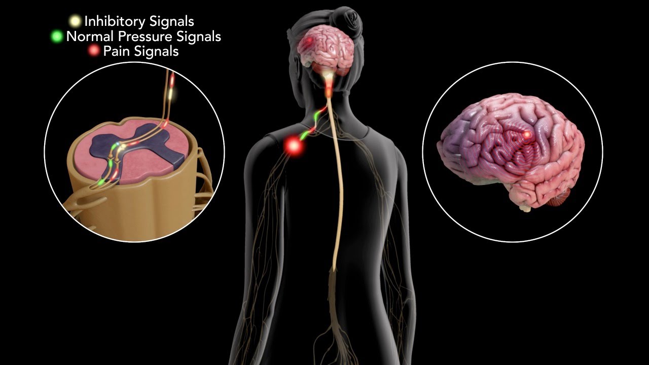 Fibromyalgia