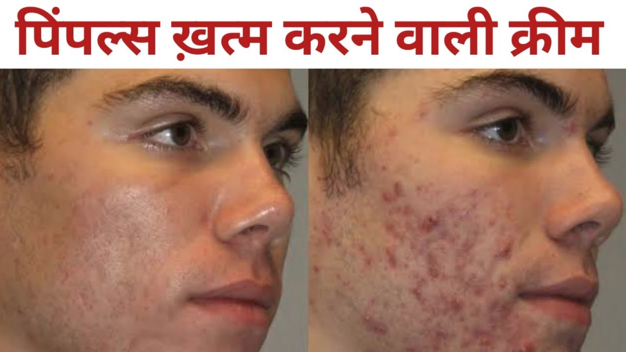 Pimple Hatane ka Tarika | Pimples Removal | Clinsol Gel