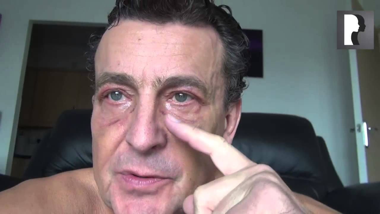 12 Male Blepharoplasty, Eyelid Lift Diary -Day 10 after surgery