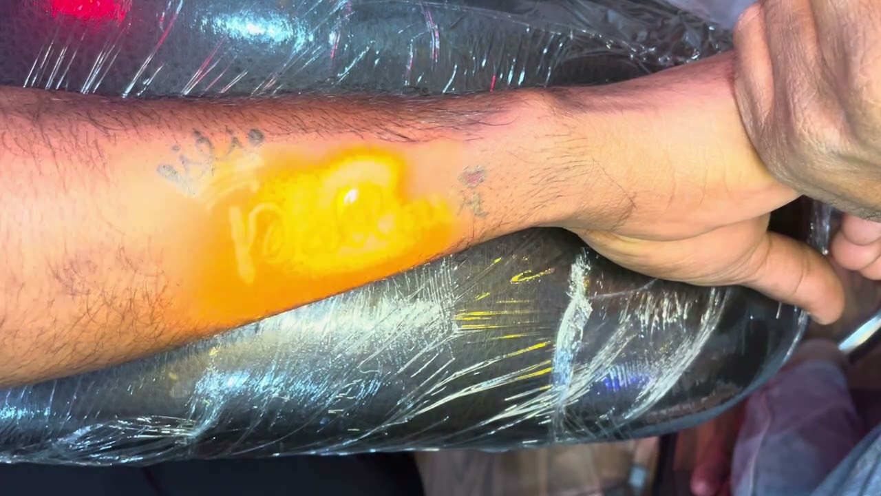 Tattoo Removal || Laser Treatment || No Scars || 💯% guarantee without any side effects plz subscribe