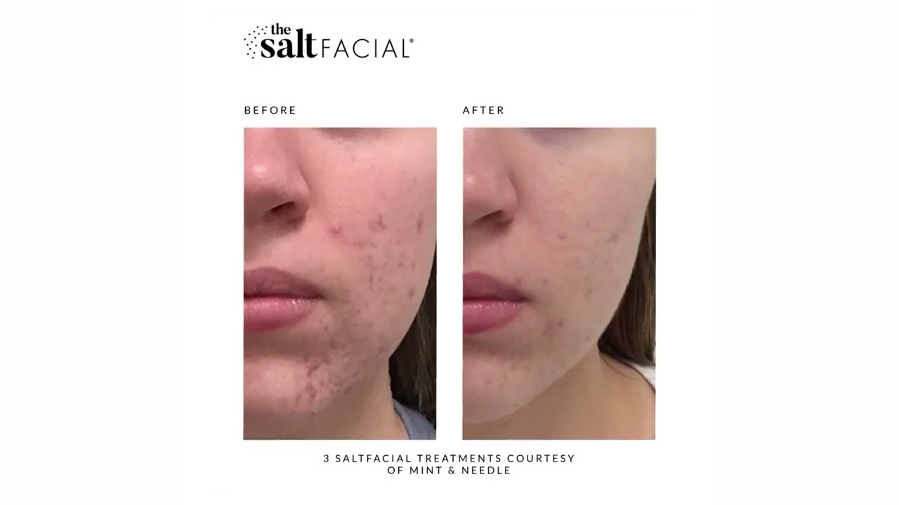 The SaltFacial® Skin Rejuvenation - Before and After Reel