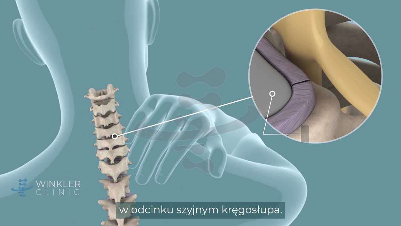 Rwa barkowo-ramienna: objawy i leczenie