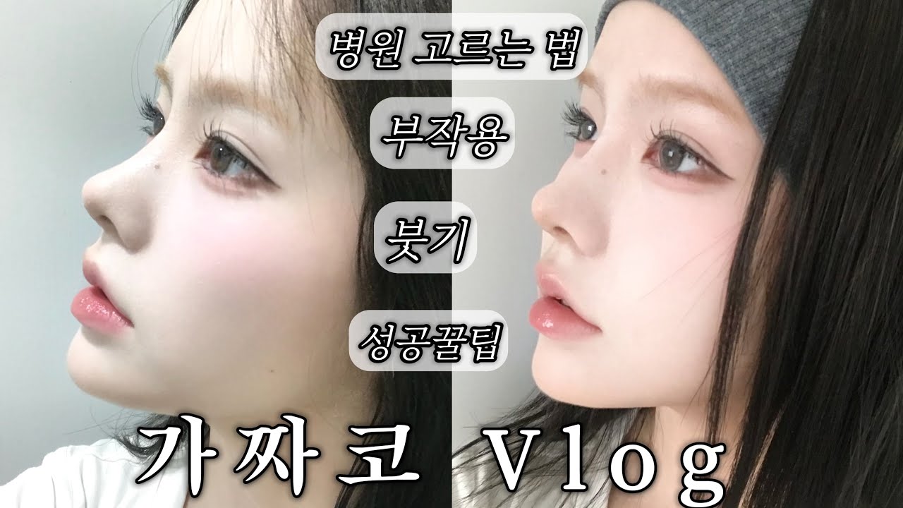 코수술 했습니다  (코재수술, 병원 고르는 꿀팁, 붓기, 흉터 꿀팁••)