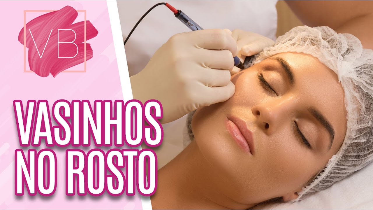 Vasinhos no rosto: causas e tratamentos - Você Bonita (19/01/2022)