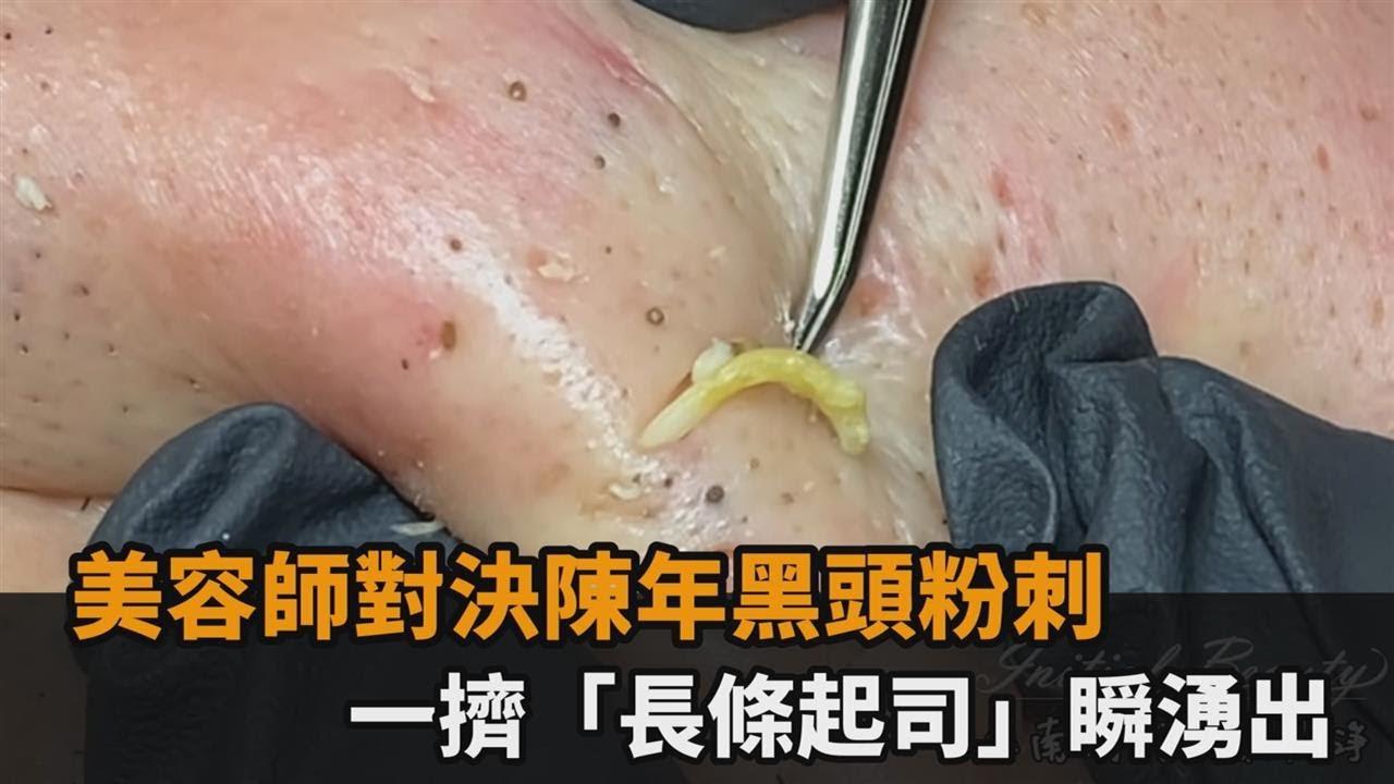 美容師對決陳年黑頭粉刺　一擠「長條起司」瞬湧出－民視新聞